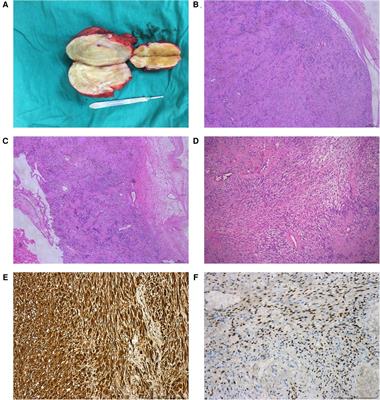 Clinical presentation, management, and research progress of adrenal schwannoma
